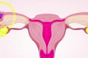 El aborto retenido o diferido