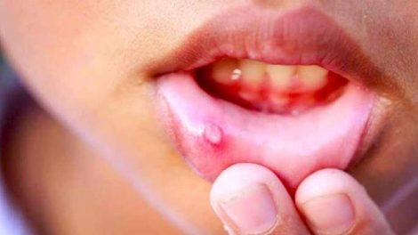 ¿Qué son las aftas bucales?