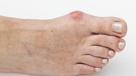 aliviar-dolor-juanetes