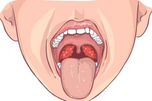 Amigdalitis o inflamación de las amigdalas