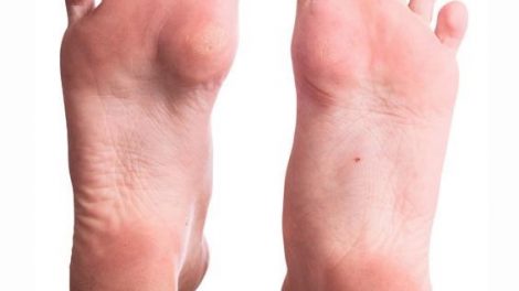 Consejos para prevenir las durezas de los pies
