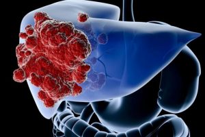 Cancer de higado