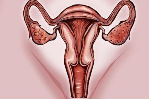 Candidiasis vaginal