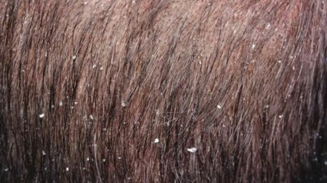 Las principales causas de la caspa