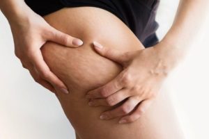 Celulitis: la guía definitiva para eliminarla
