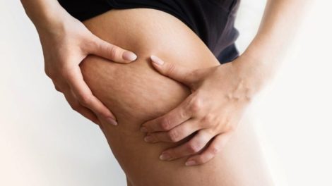 Celulitis: la guía definitiva para eliminarla