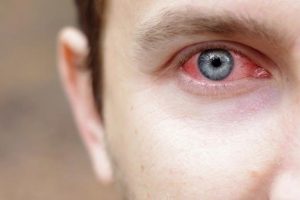 conjuntivitis