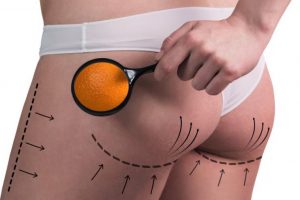 consejos-celulitis