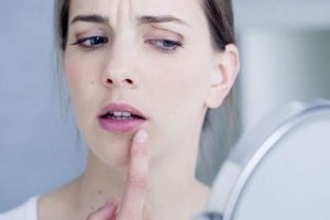 Consejos naturales contra el herpes labial