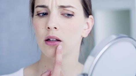 Consejos naturales contra el herpes labial