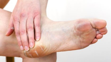 Consejos naturales para aliviar rozaduras de zapatos