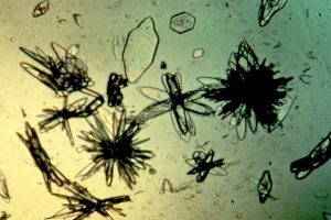 ¿Cómo disolver los cristales de ácido úrico naturalmente?