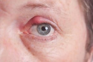 El orzuelo se puede curar naturalmente