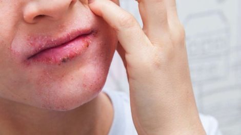 Dermatitis atópica en los labios