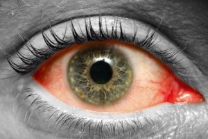 Causas del desprendimiento de retina