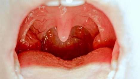 Cuidados tras la extirpación de las amígdalas