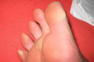 Descubre algunos consejos naturales para quitar los callos de manos y pies