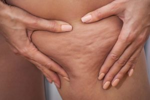 Consejos contra la celulitis