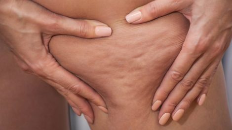 Consejos contra la celulitis