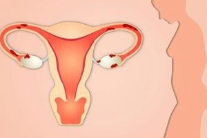 endometriosis