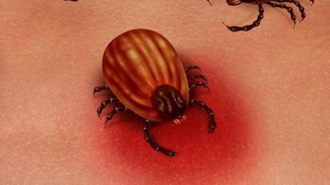 Enfermedades infecciosas por picadura de garrapata