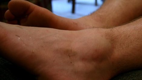 Prevención del esguince de tobillo