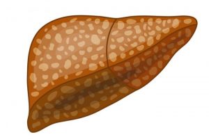Esteatosis hepatica