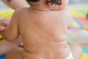 Exantema súbito en bebés