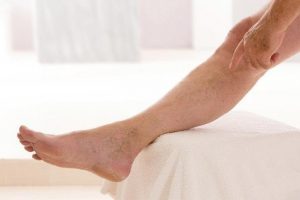 flebitis