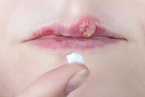 Herpes en labios
