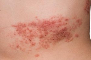 Herpes zoster