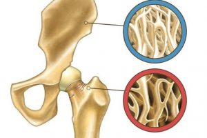 hipocalcemia