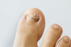 Síntomas de los hongos en los pies