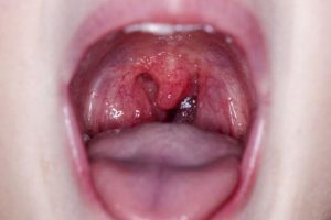 Las causas de la inflamación de las amígdalas