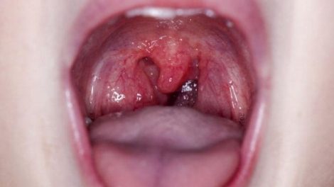 Las causas de la inflamación de las amígdalas