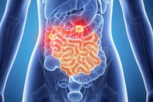 Todo sobre el intestino irritable