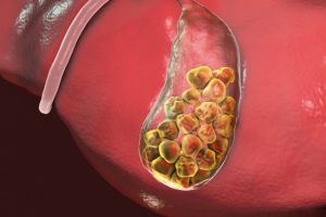 Litiasis biliar