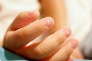 Manchas blancas en las uñas