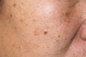 melasma