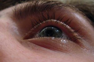 ojos-hinchados