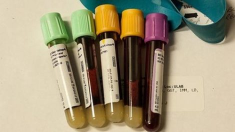 Todo sobre el pH de la sangre