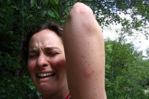 picaduras-mosquito-pican