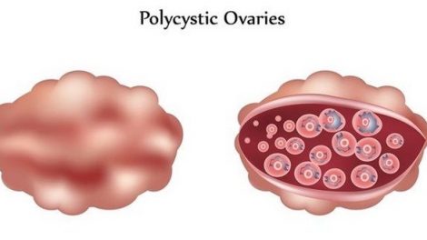 En qué consiste la poliquistosis ovárica y por qué aparece