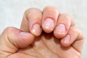 Problemas de las uñas