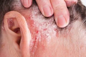 psoriasis