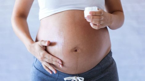 Remedios caseros para las estrías