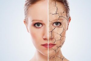 Consejos para mejorar la piel agrietada naturalmente