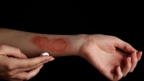 Remedios para aliviar las quemaduras superficiales