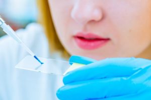 Test de sangre para el diagnostico temprano del cancer de pancreas