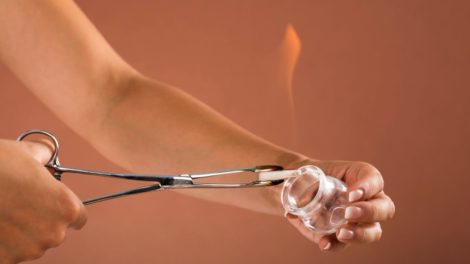 Todo sobre el Cupping para eliminar la celulitis